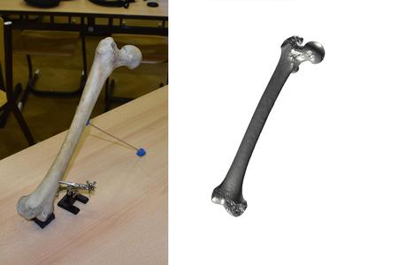 Thigh Bone Scan – Femur