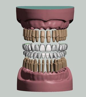 Maxillary and Mandibular dental models crowns and preped dies